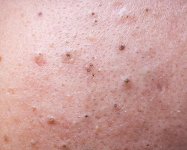 Trị Mụn Đầu Đen Hiệu Quả Tại Sen Beauty